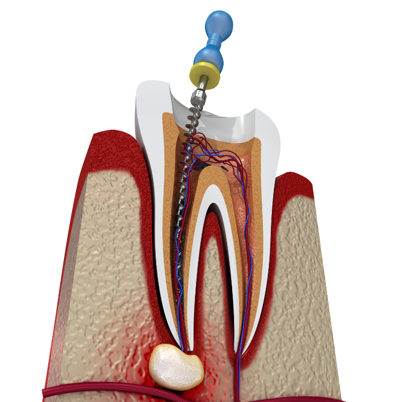 Root Canal: What You Need To Know